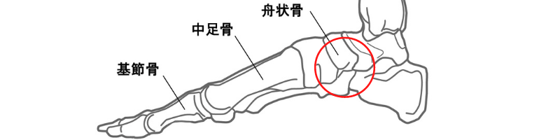 有痛性外脛骨症とは